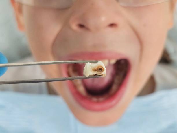 Best Root Canal Emergency Dentist  in Atwater, MN
